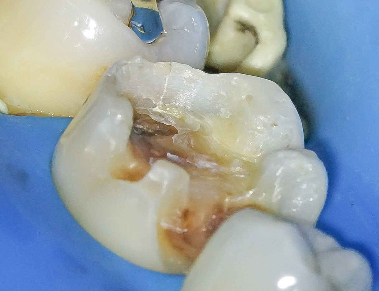 銀歯を外しハイトランスジルコニアにて修復した症例治療方法04