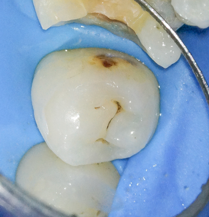 【症例】銀歯を外しハイトランスジルコニアにて修復した症例治療方法08