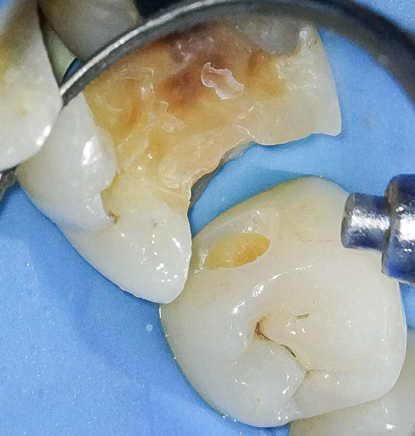 【症例】銀歯を外しハイトランスジルコニアにて修復した症例治療方法09