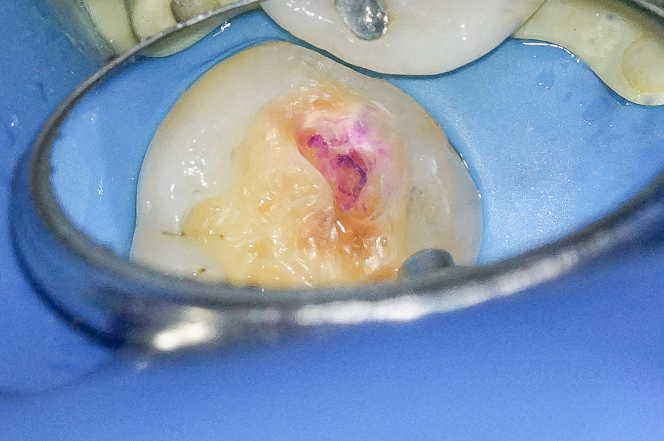 【症例】銀歯を外しハイトランスジルコニアにて修復した症例治療方法06
