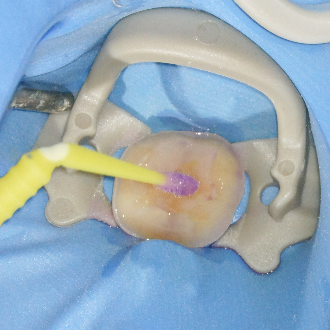 銀歯を外しハイトランスジルコニアにて修復した症例治療方法13