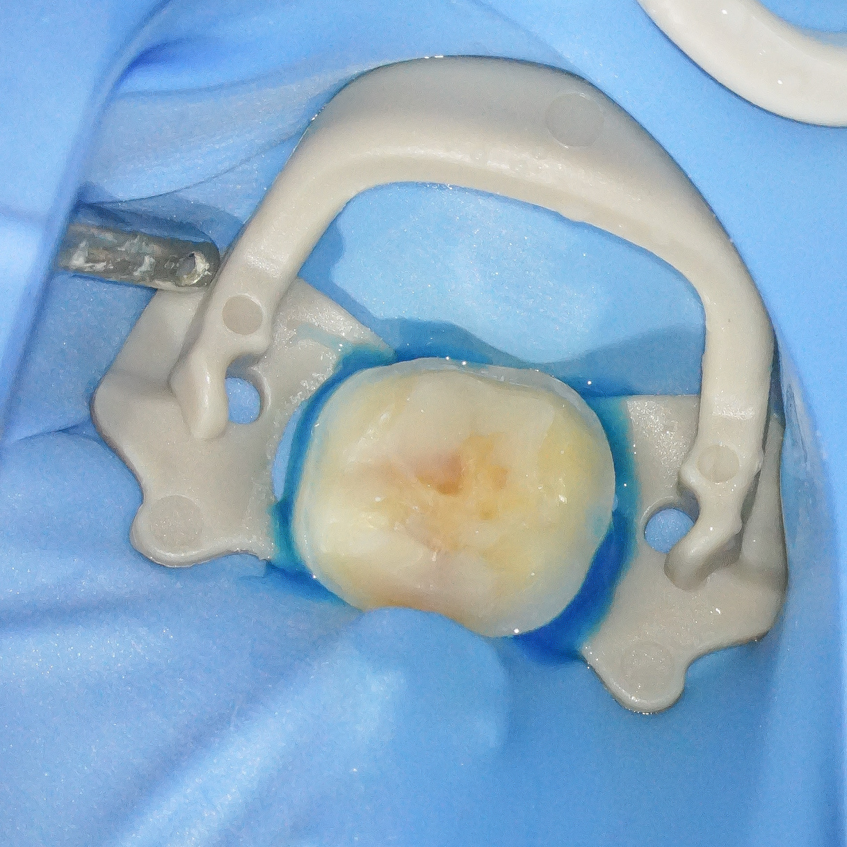 銀歯を外しハイトランスジルコニアにて修復した症例治療方法14