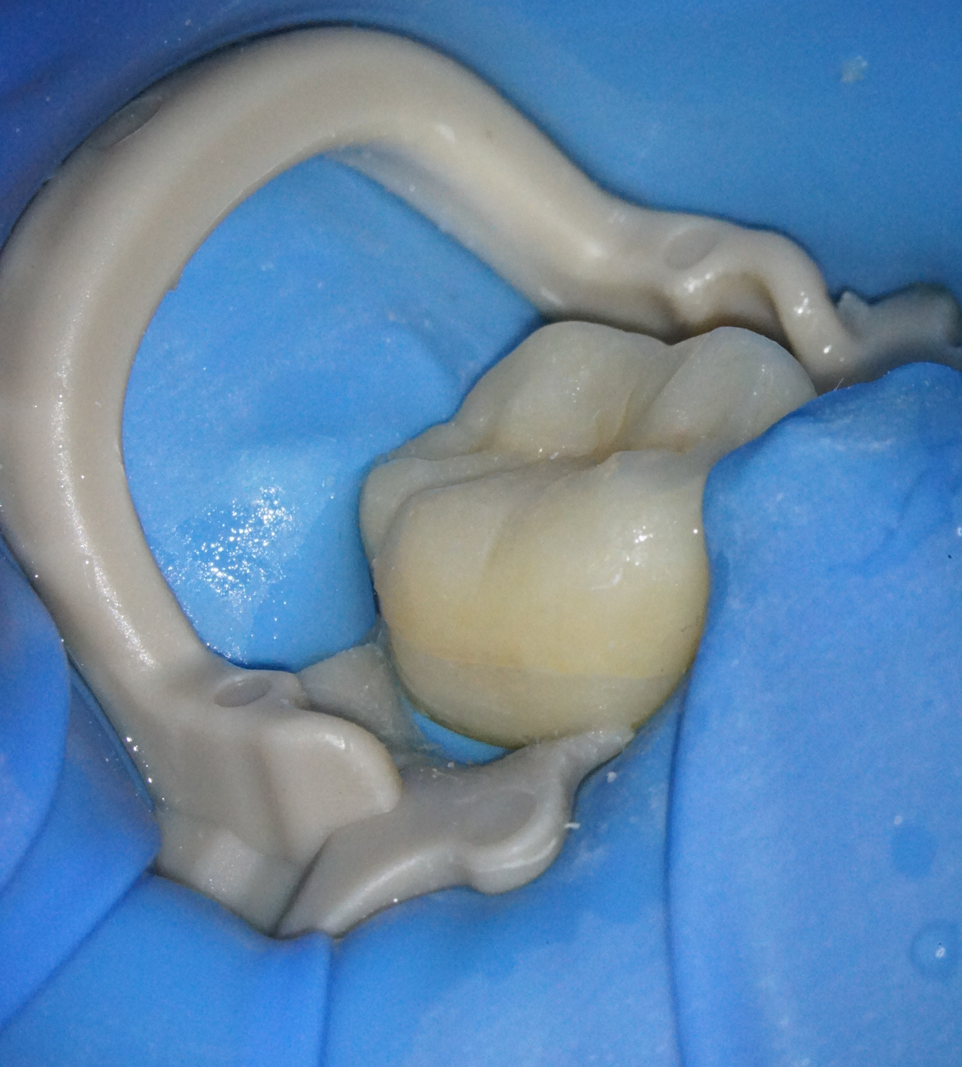 銀歯を外しハイトランスジルコニアにて修復した症例治療方法16