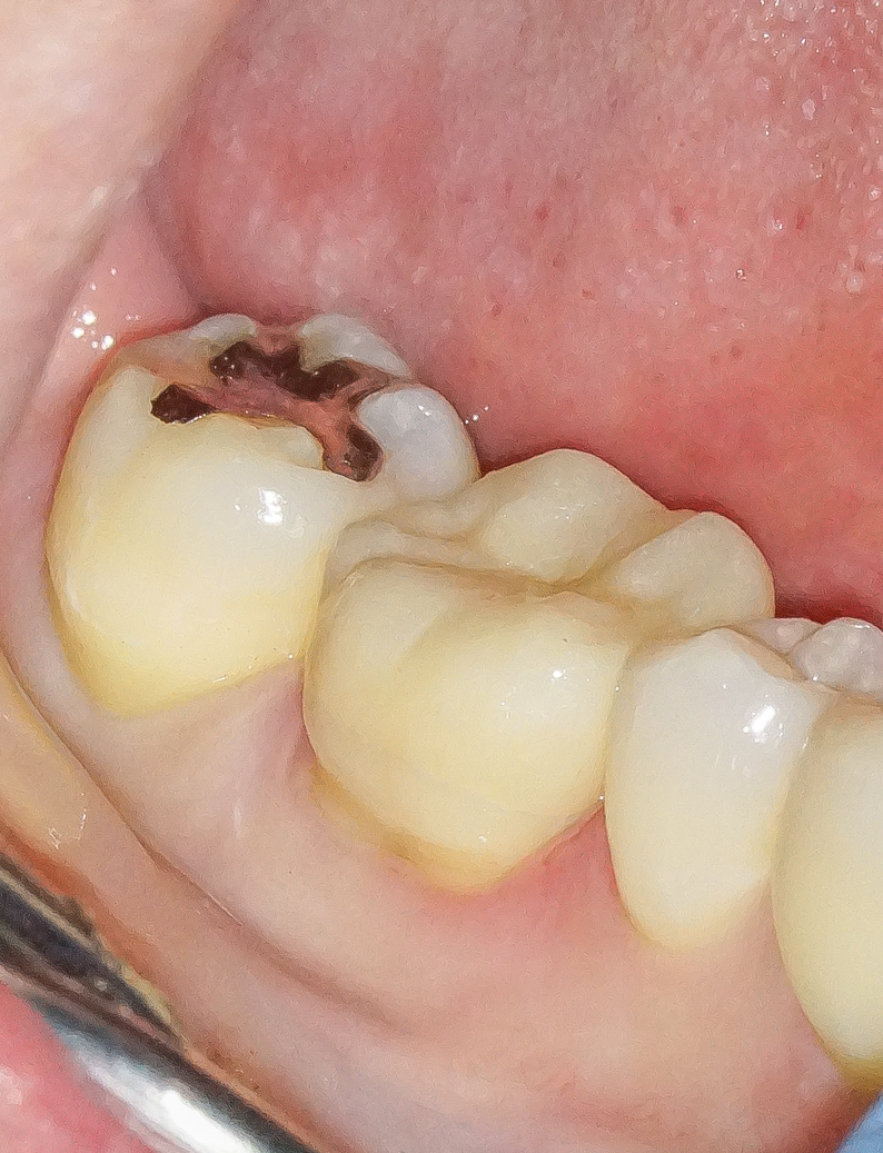銀歯を外しハイトランスジルコニアにて修復した症例治療方法17