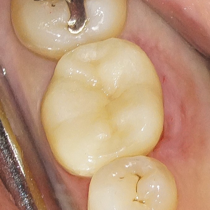 【症例】銀歯を外しハイトランスジルコニアにて修復した症例BEFORE