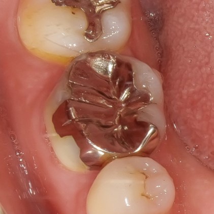 銀歯を外しハイトランスジルコニアにて修復した症例BEFORE