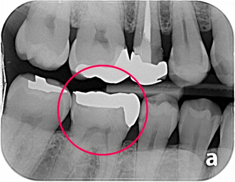 銀歯を外しハイトランスジルコニアにて修復した症例治療方法02
