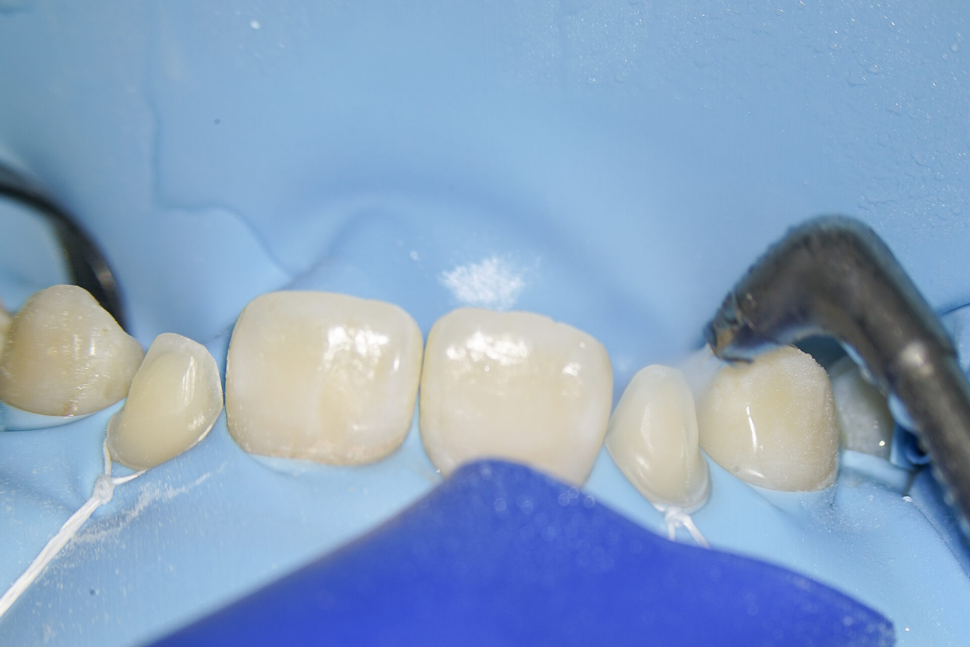 【症例】矮小歯・すきっ歯を、部分的矯正治療＋歯肉整形＋ラミネートベニヤにて改善した症例治療方法13