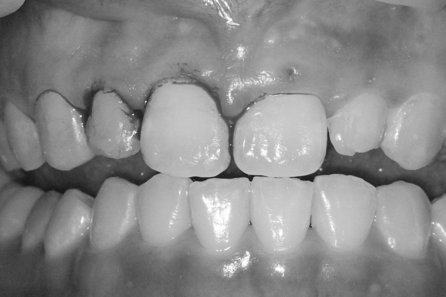 【症例】矮小歯・すきっ歯を、部分的矯正治療＋歯肉整形＋ラミネートベニヤにて改善した症例治療方法05