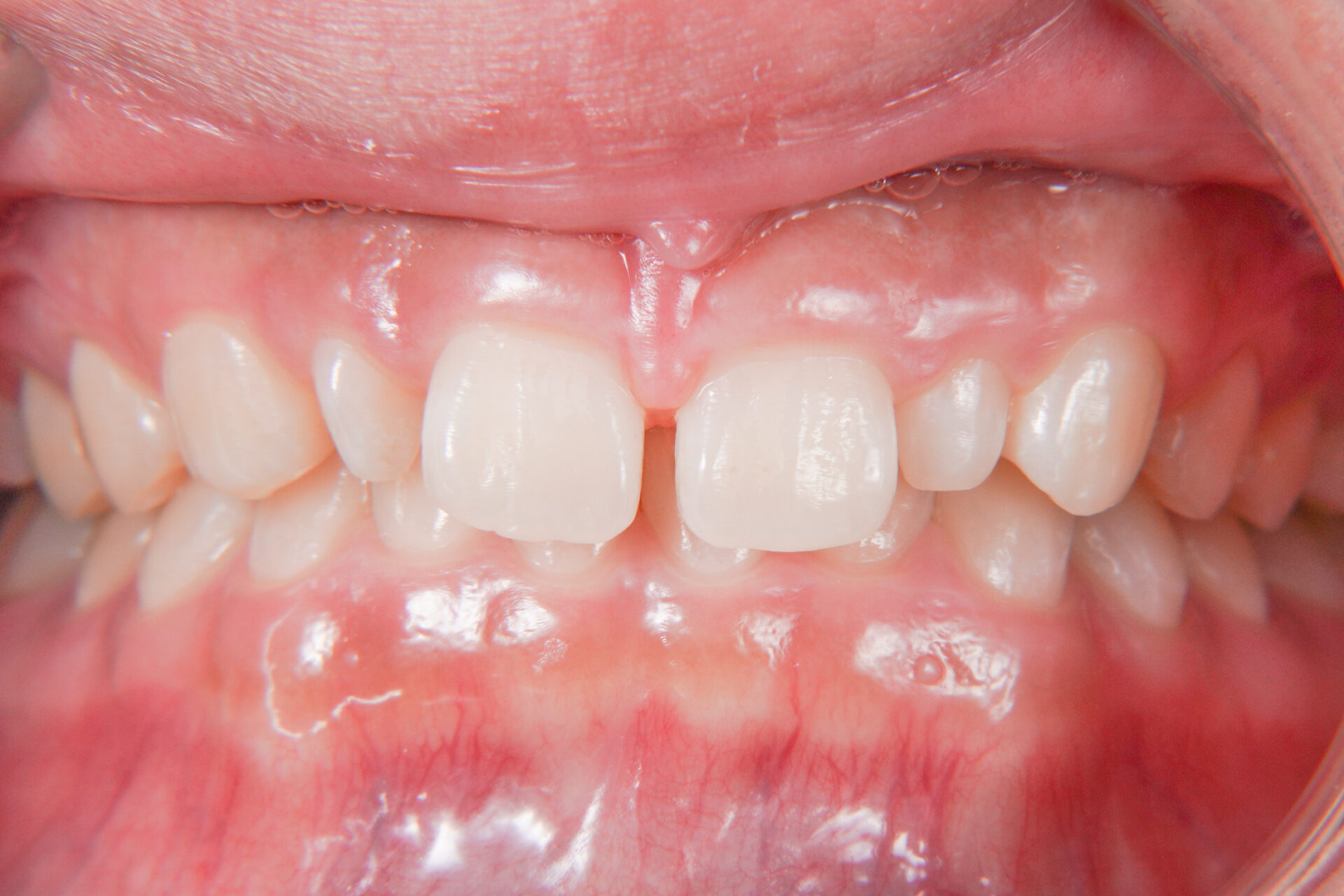 【症例】矮小歯・すきっ歯を、部分的矯正治療＋歯肉整形＋ラミネートベニヤにて改善した症例治療方法02