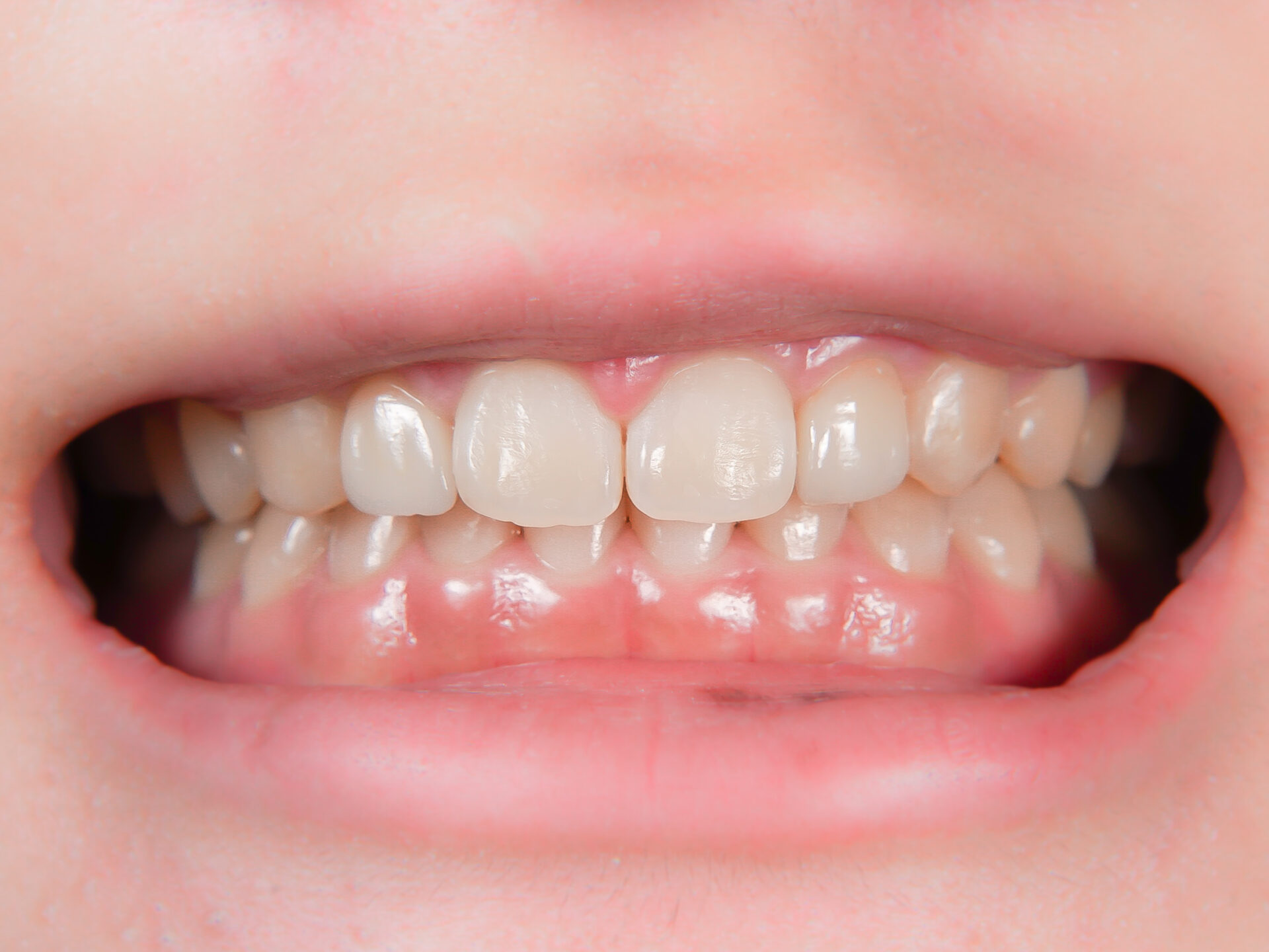 【症例】矮小歯・すきっ歯を、部分的矯正治療＋歯肉整形＋ラミネートベニヤにて改善した症例BEFORE