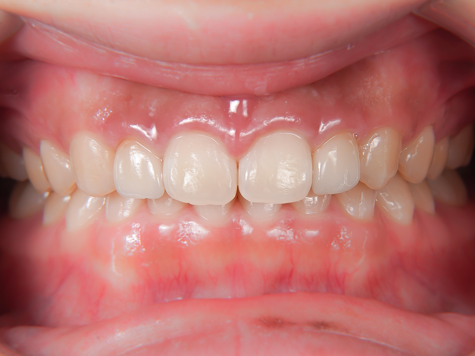 【症例】矮小歯・すきっ歯を、部分的矯正治療＋歯肉整形＋ラミネートベニヤにて改善した症例治療方法18