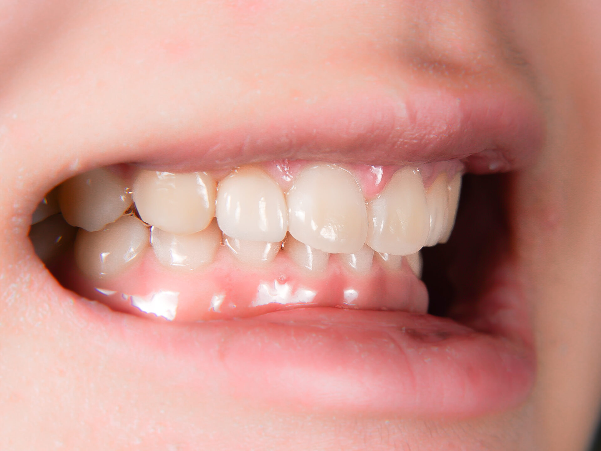 【症例】矮小歯・すきっ歯を、部分的矯正治療＋歯肉整形＋ラミネートベニヤにて改善した症例治療方法20