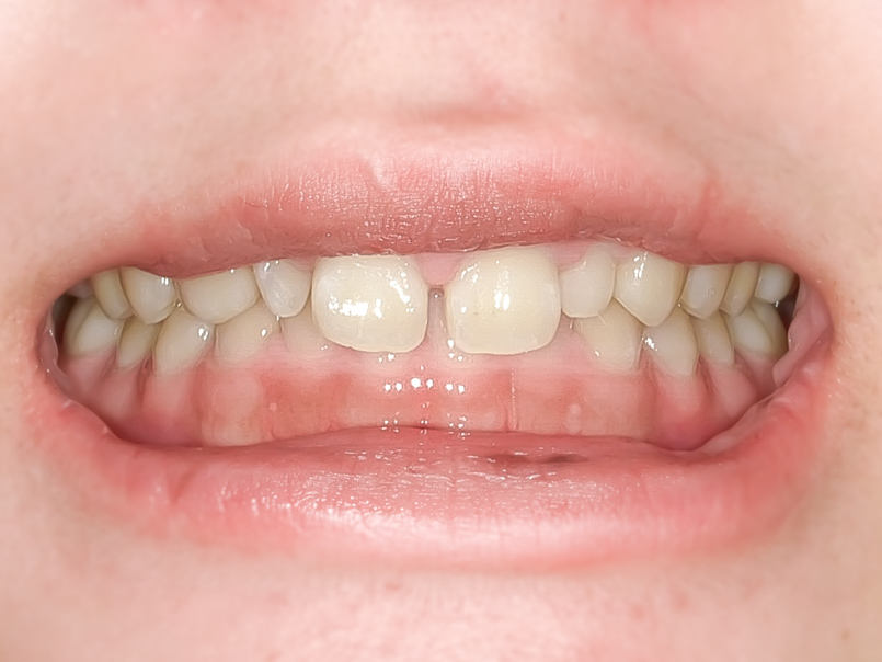 【症例】矮小歯・すきっ歯を、部分的矯正治療＋歯肉整形＋ラミネートベニヤにて改善した症例BEFORE