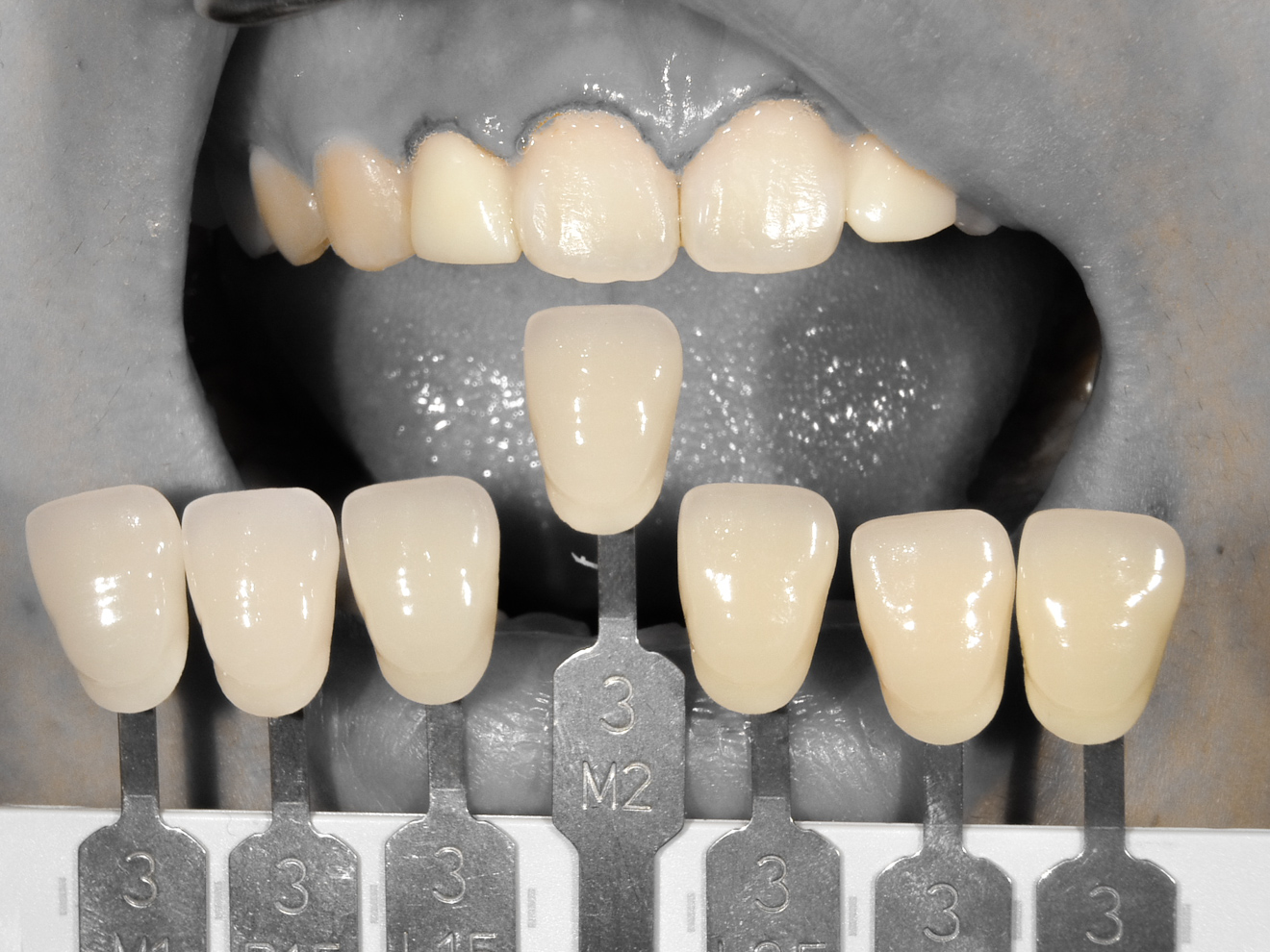 【症例】矮小歯・すきっ歯を、部分的矯正治療＋歯肉整形＋ラミネートベニヤにて改善した症例治療方法10