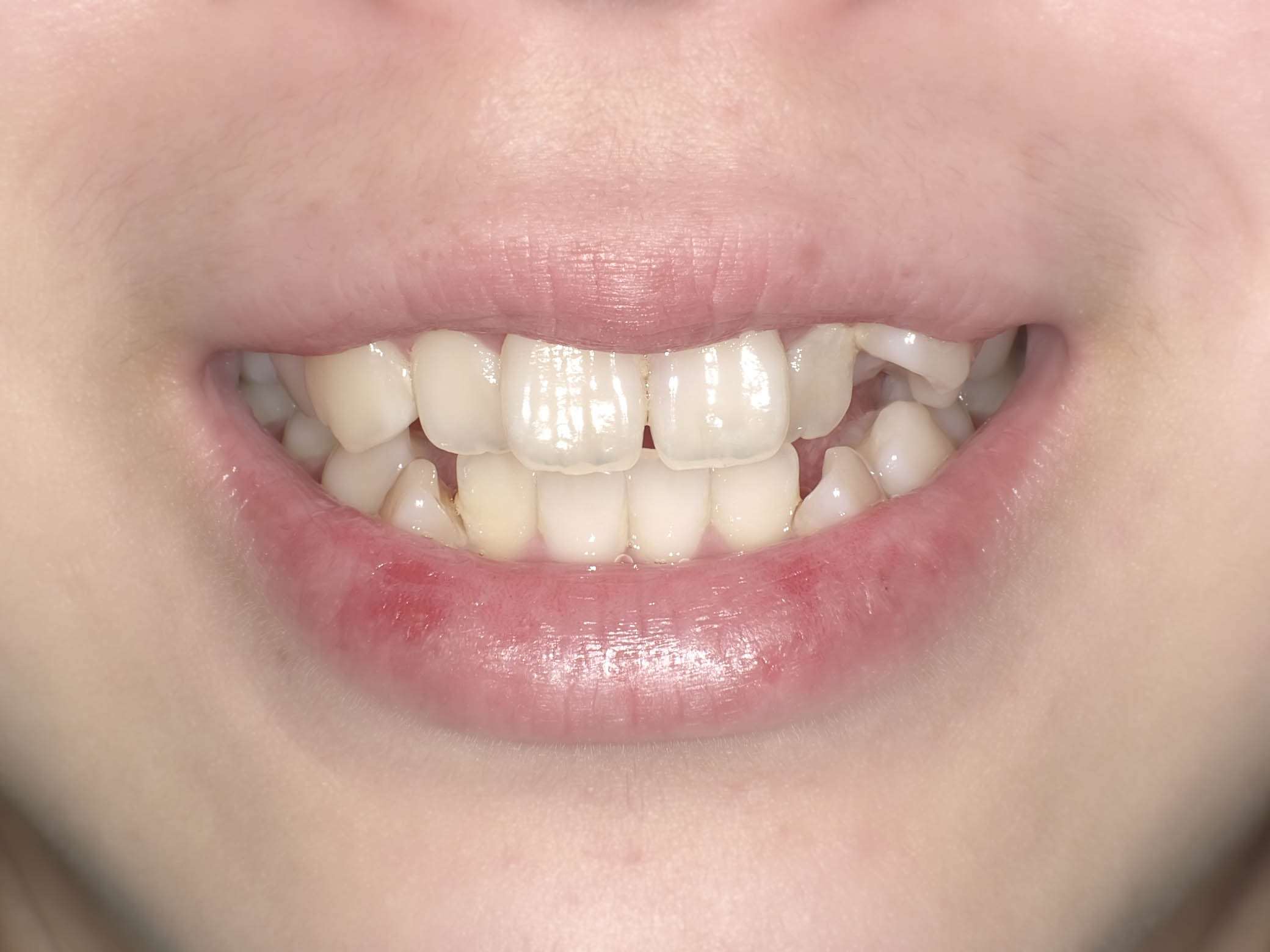 歯列矯正によって口ゴボが改善したケースBEFORE