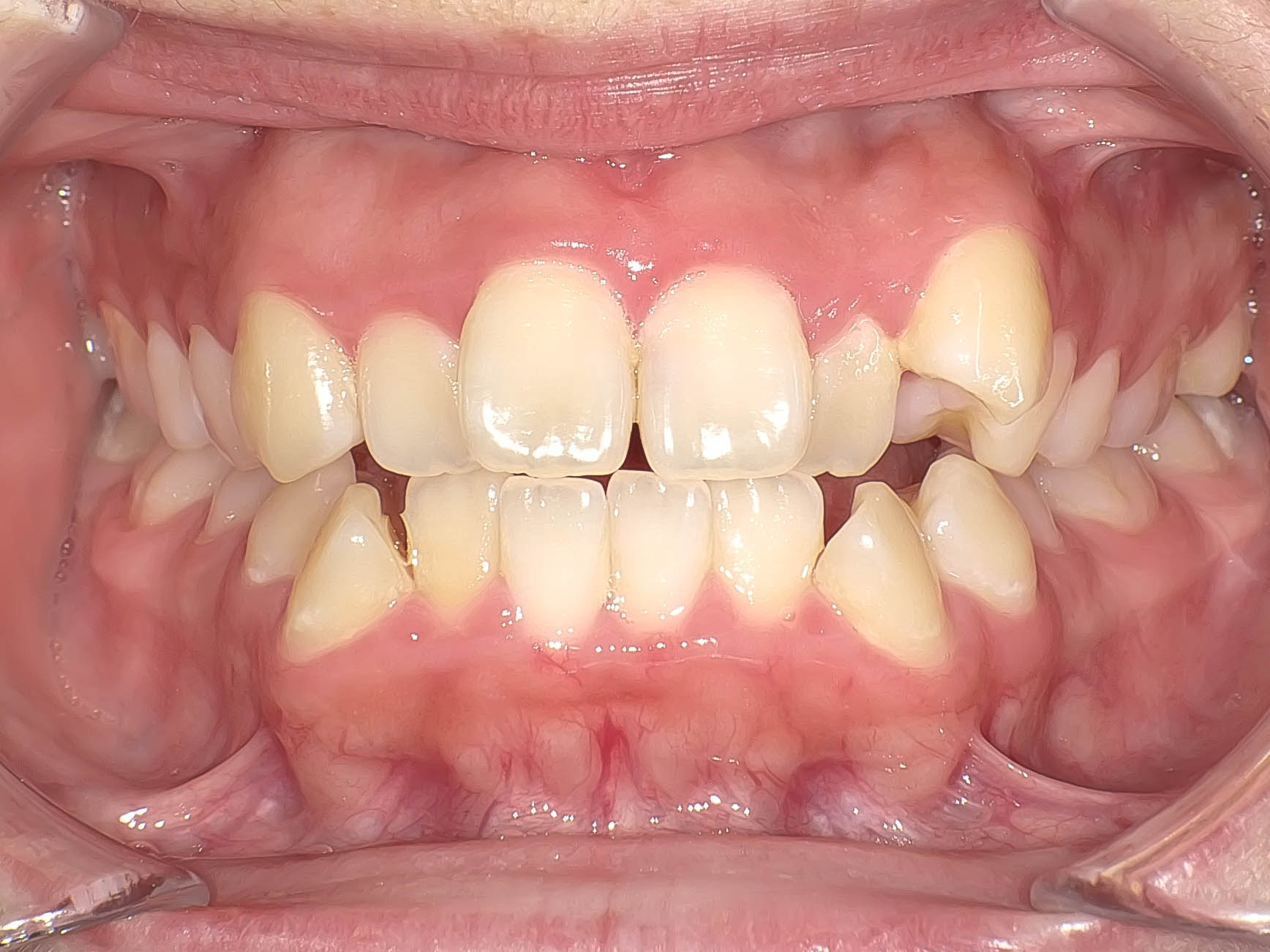 【症例】歯列矯正によって口ゴボが改善したケース治療方法01