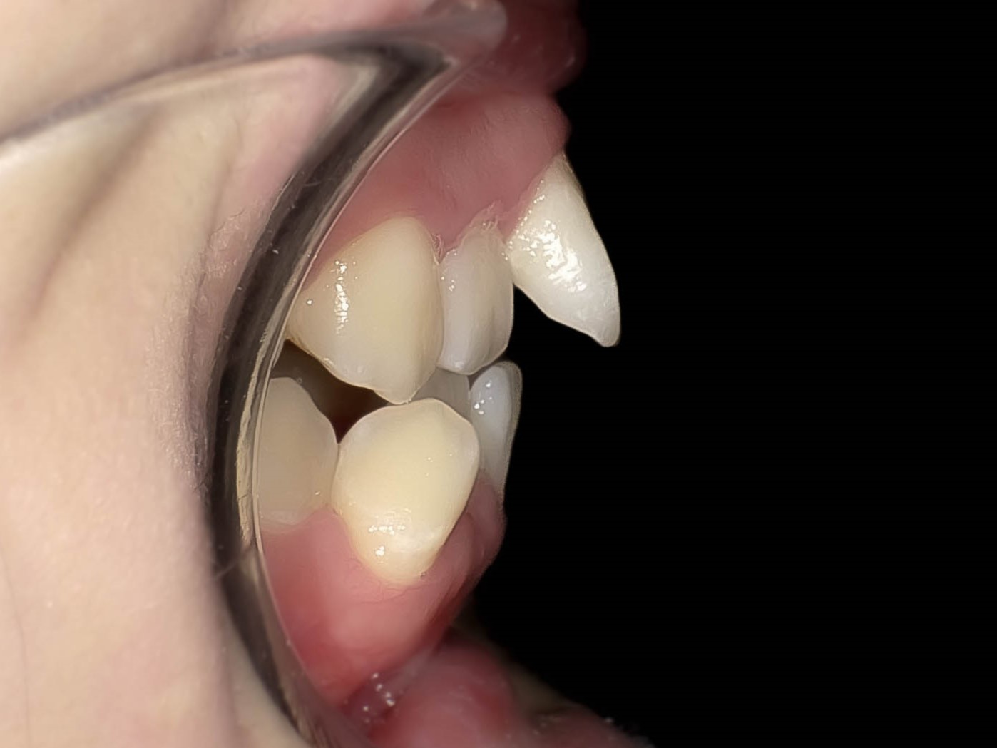 【症例】歯列矯正によって口ゴボが改善したケース治療方法05