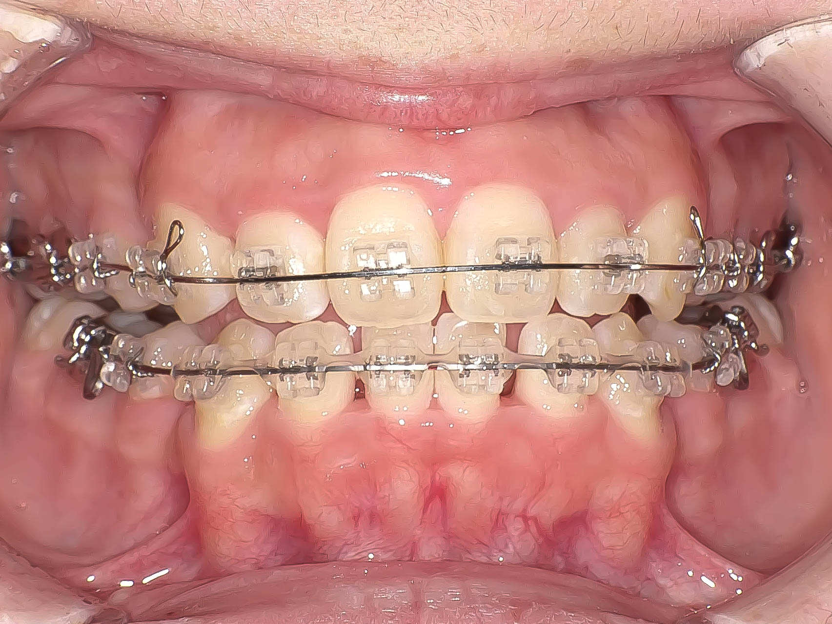 【症例】歯列矯正によって口ゴボが改善したケース治療方法03