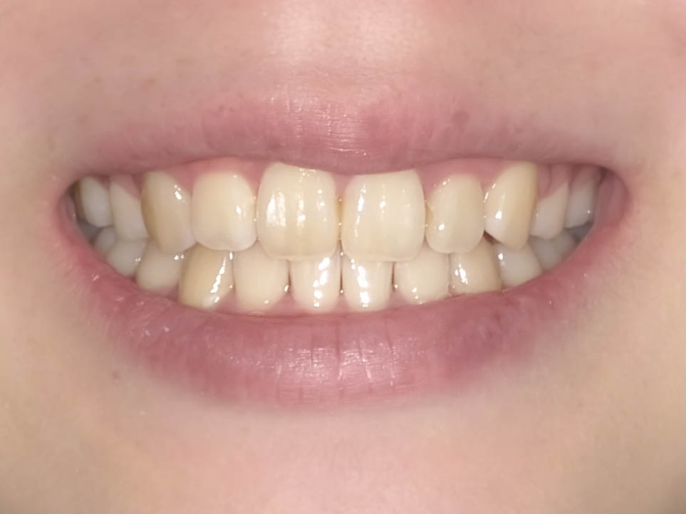 【症例】歯列矯正によって口ゴボが改善したケース治療方法07