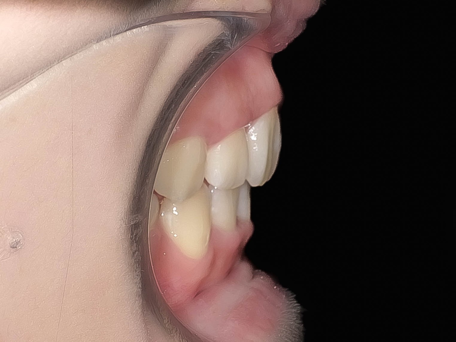 【症例】歯列矯正によって口ゴボが改善したケース治療方法06