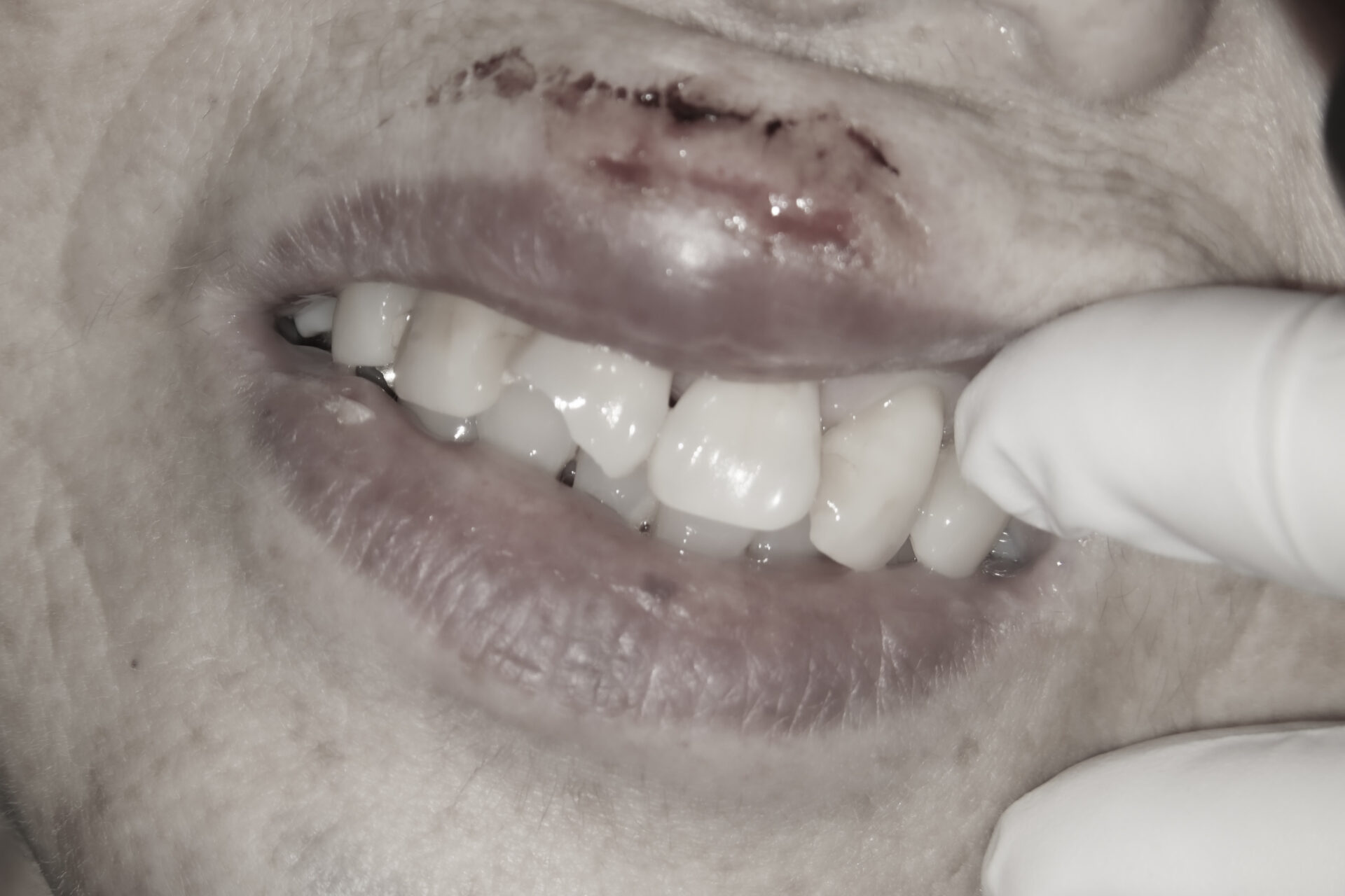 歯が折れた、歯が欠けたという外傷の状態をダイレクトボンディングにて修復治療方法02