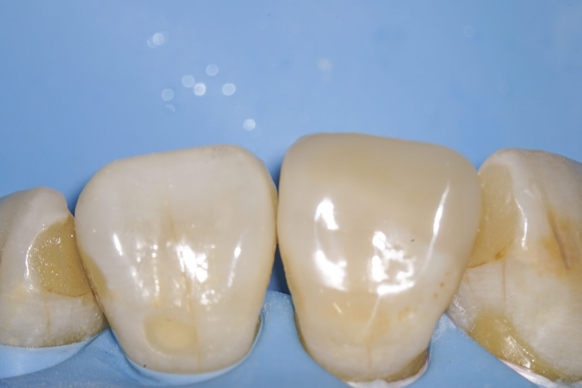 歯が折れた、歯が欠けたという外傷の状態をダイレクトボンディングにて修復治療方法10