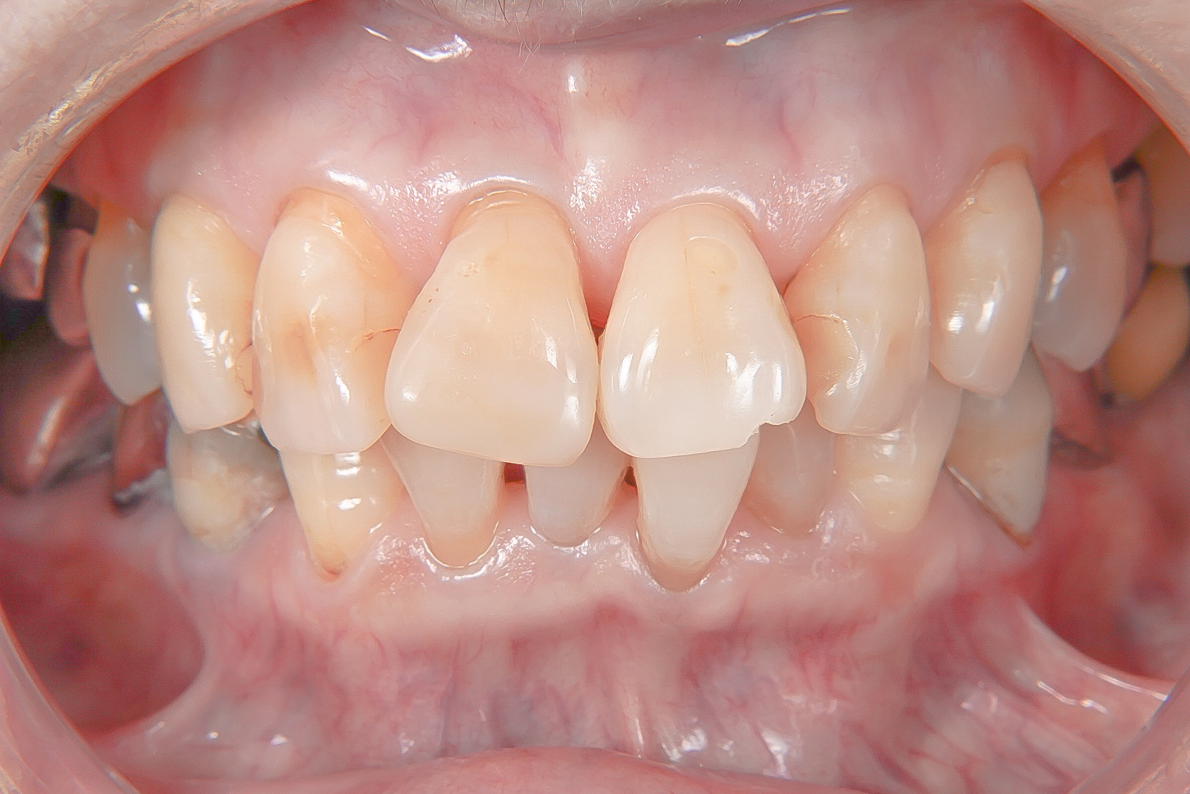 歯が折れた、歯が欠けたという外傷の状態をダイレクトボンディングにて修復治療方法11