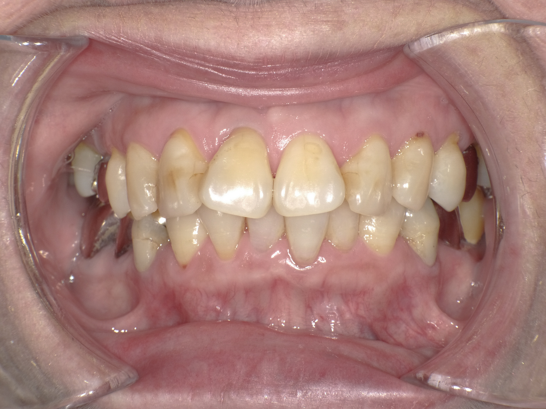 歯が折れた、歯が欠けたという外傷の状態をダイレクトボンディングにて修復治療方法03