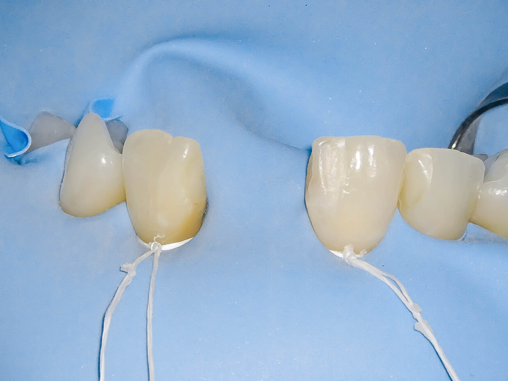 歯根破折により抜歯となった歯を機能的、審美的に回復させたケース治療方法04