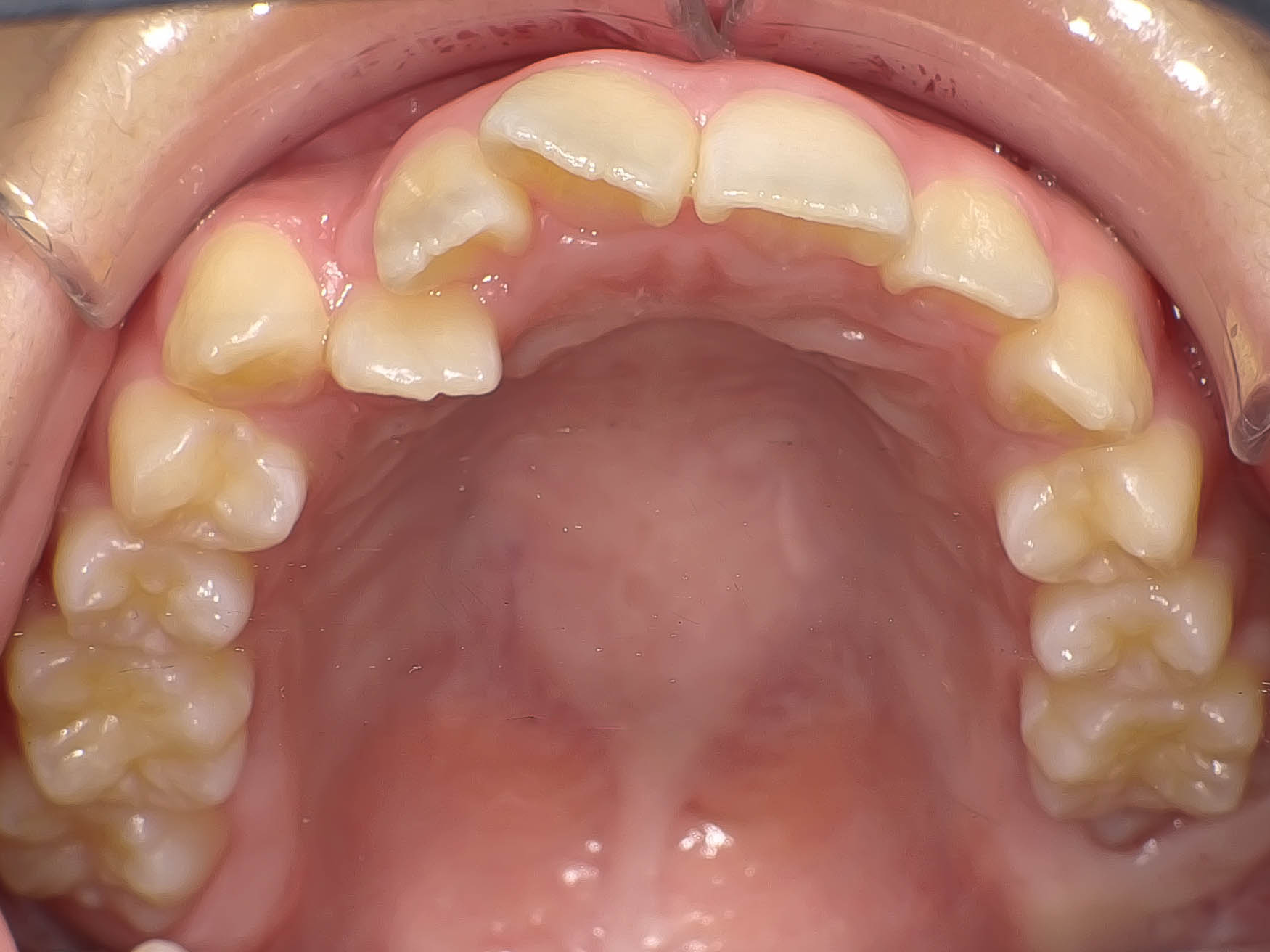 叢生（歯のガタガタ）の矯正治療治療方法02
