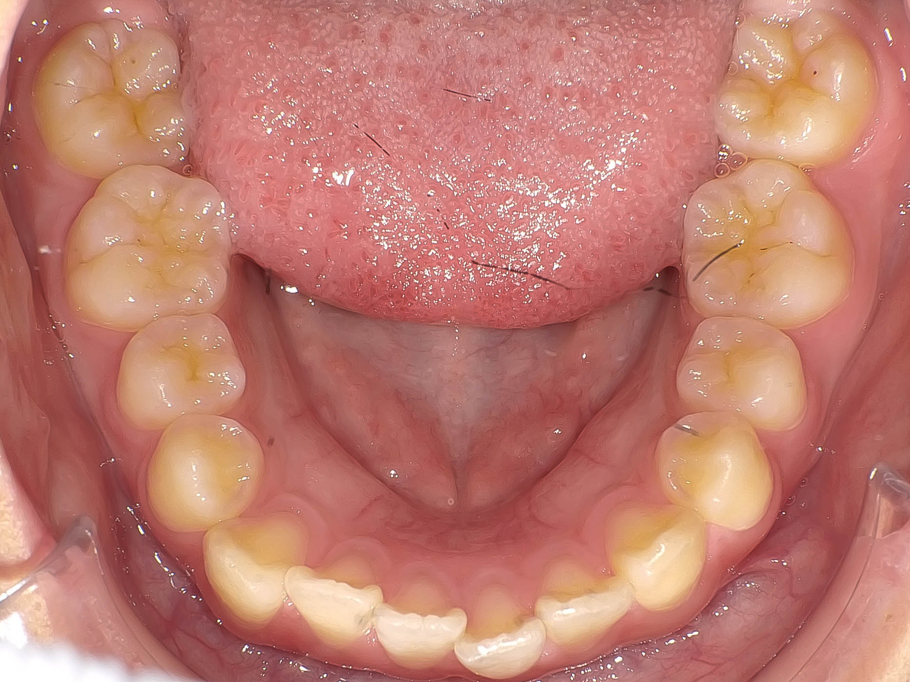 叢生（歯のガタガタ）の矯正治療治療方法04