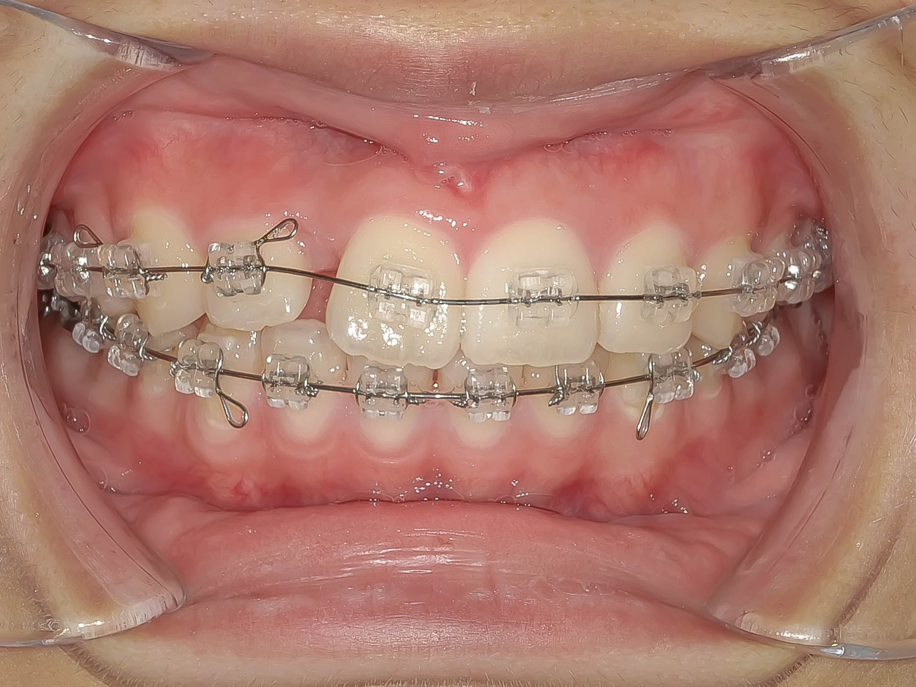 叢生（歯のガタガタ）の矯正治療治療方法05