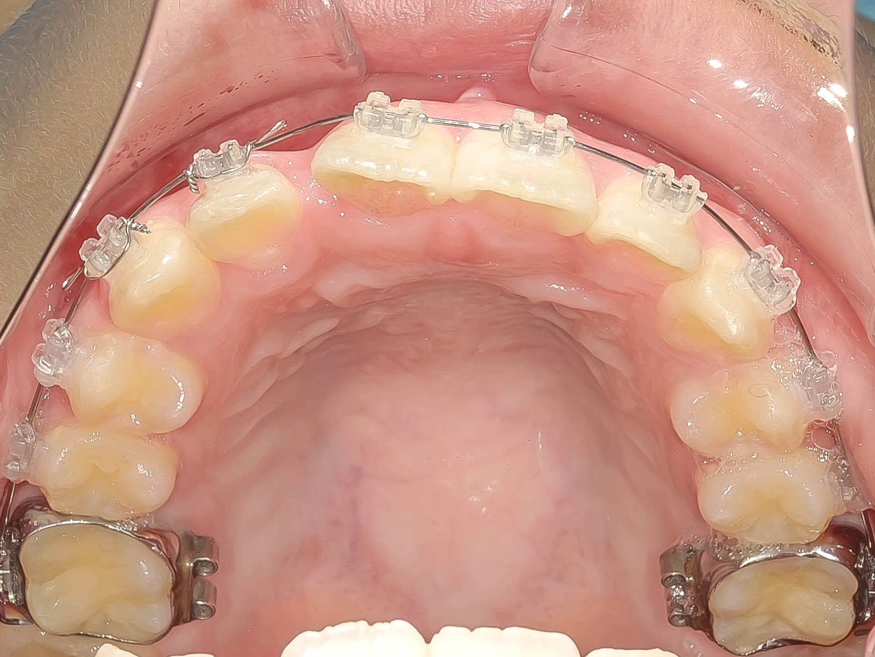 叢生（歯のガタガタ）の矯正治療治療方法06