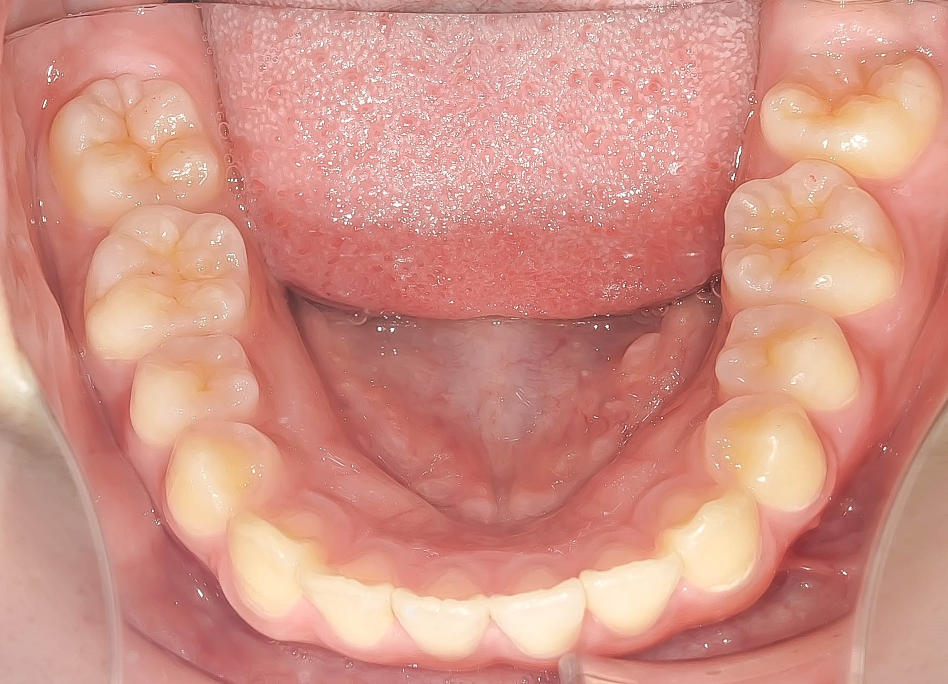 叢生（歯のガタガタ）の矯正治療治療方法09