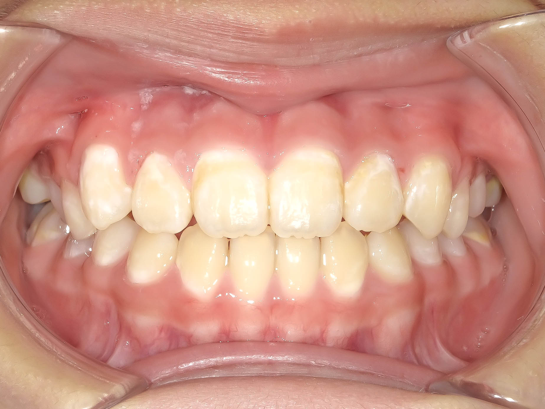 【症例】すきっ歯に対するこどもの矯正治療
