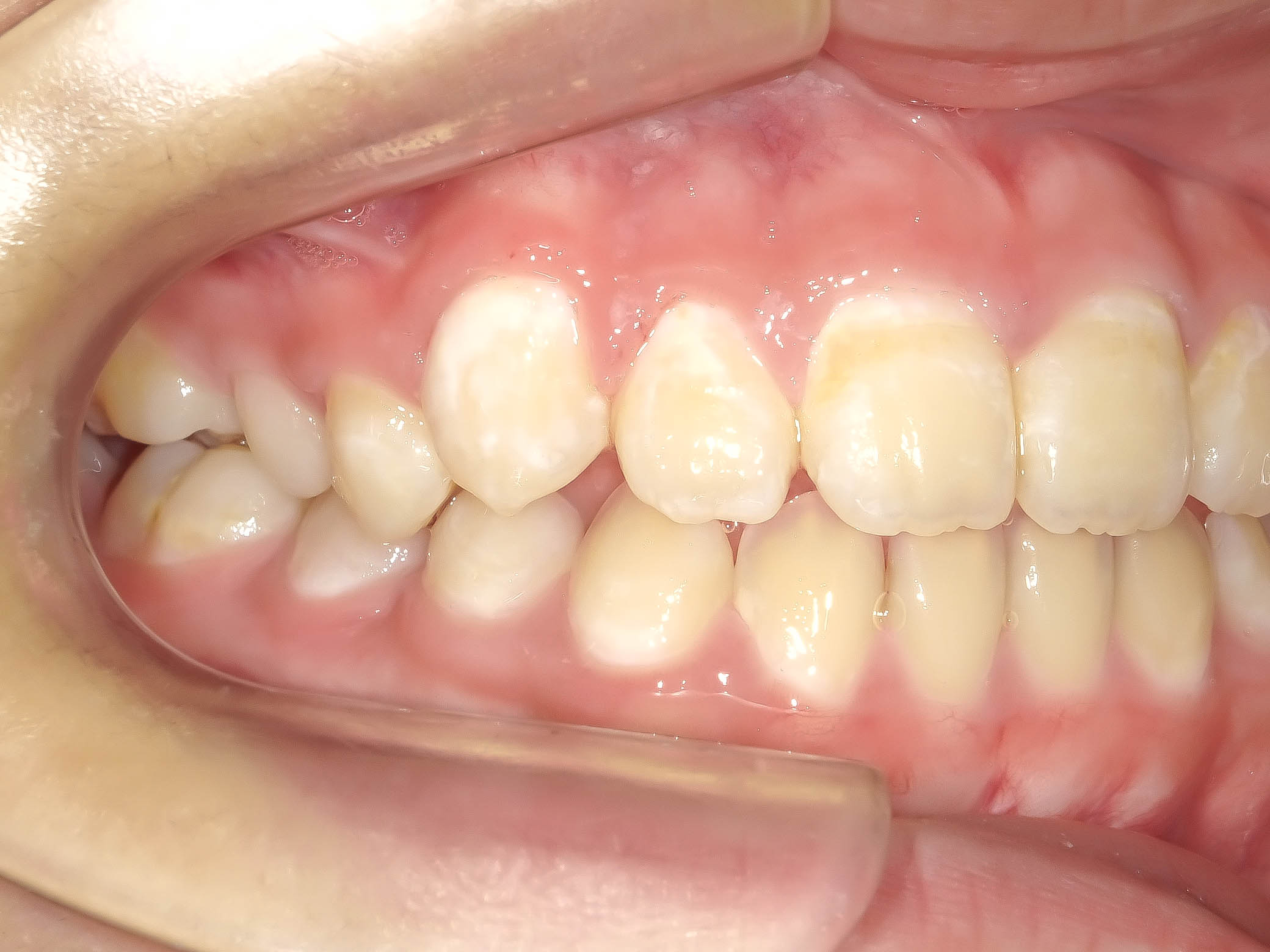 こどもの矯正、すきっ歯を治す矯正治療治療方法05