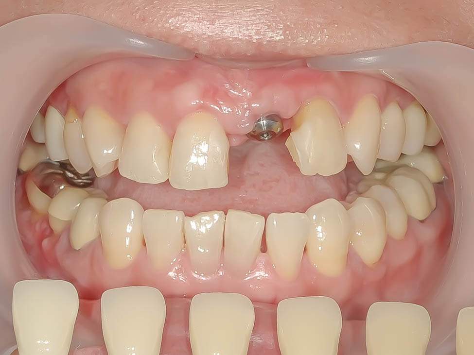 歯根破折により抜歯となった歯を機能的、審美的に回復させたケース治療方法02