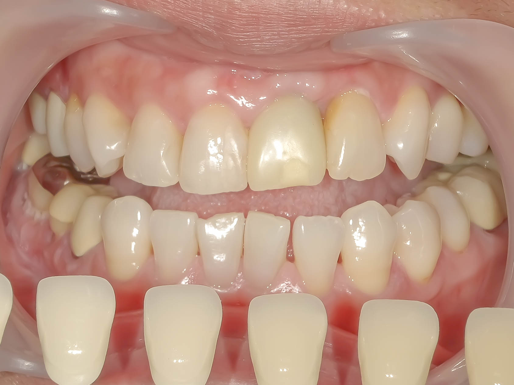 歯根破折により抜歯となった歯を機能的、審美的に回復させたケース治療方法03