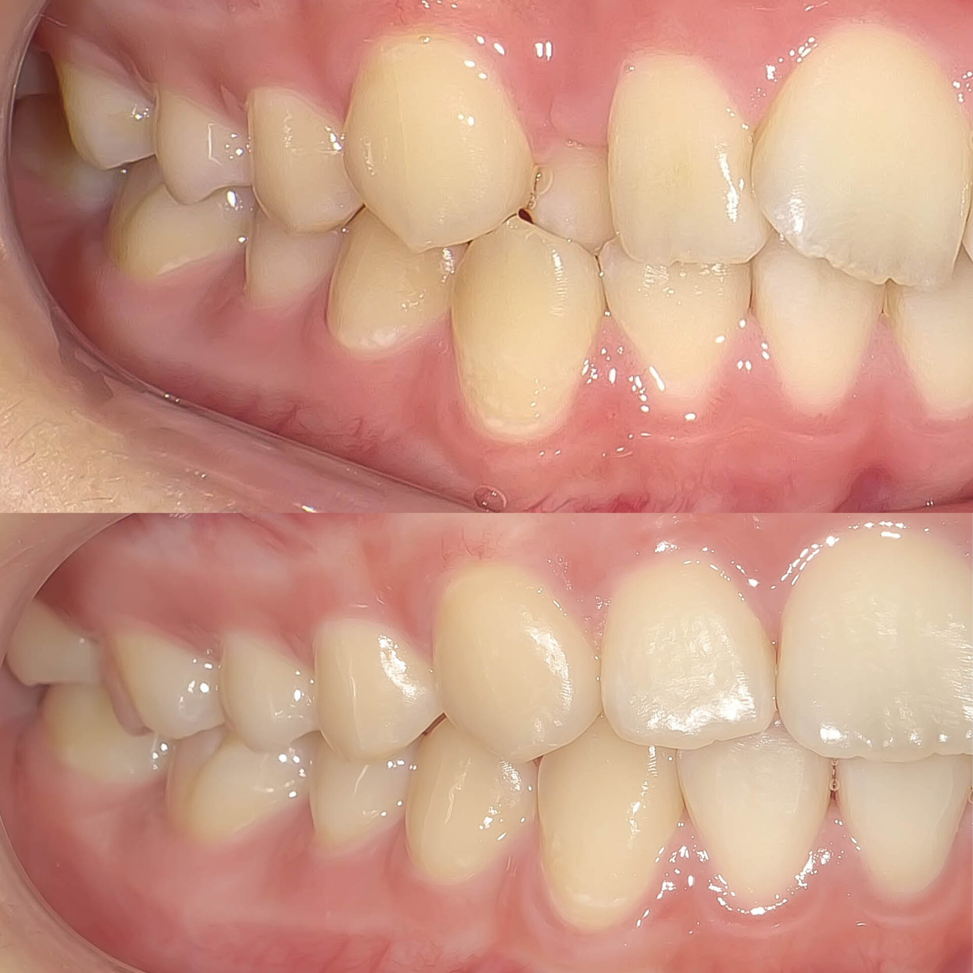 叢生（歯のガタガタ）の矯正治療治療方法11