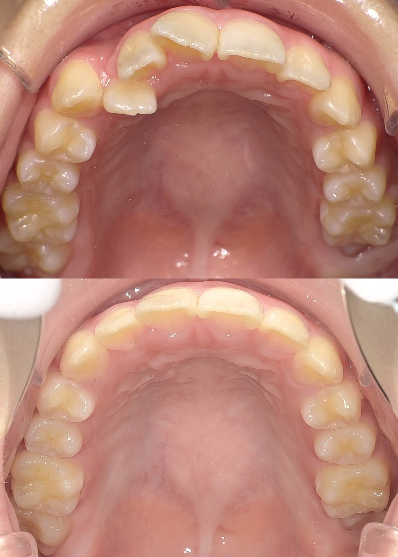 叢生（歯のガタガタ）の矯正治療治療方法10