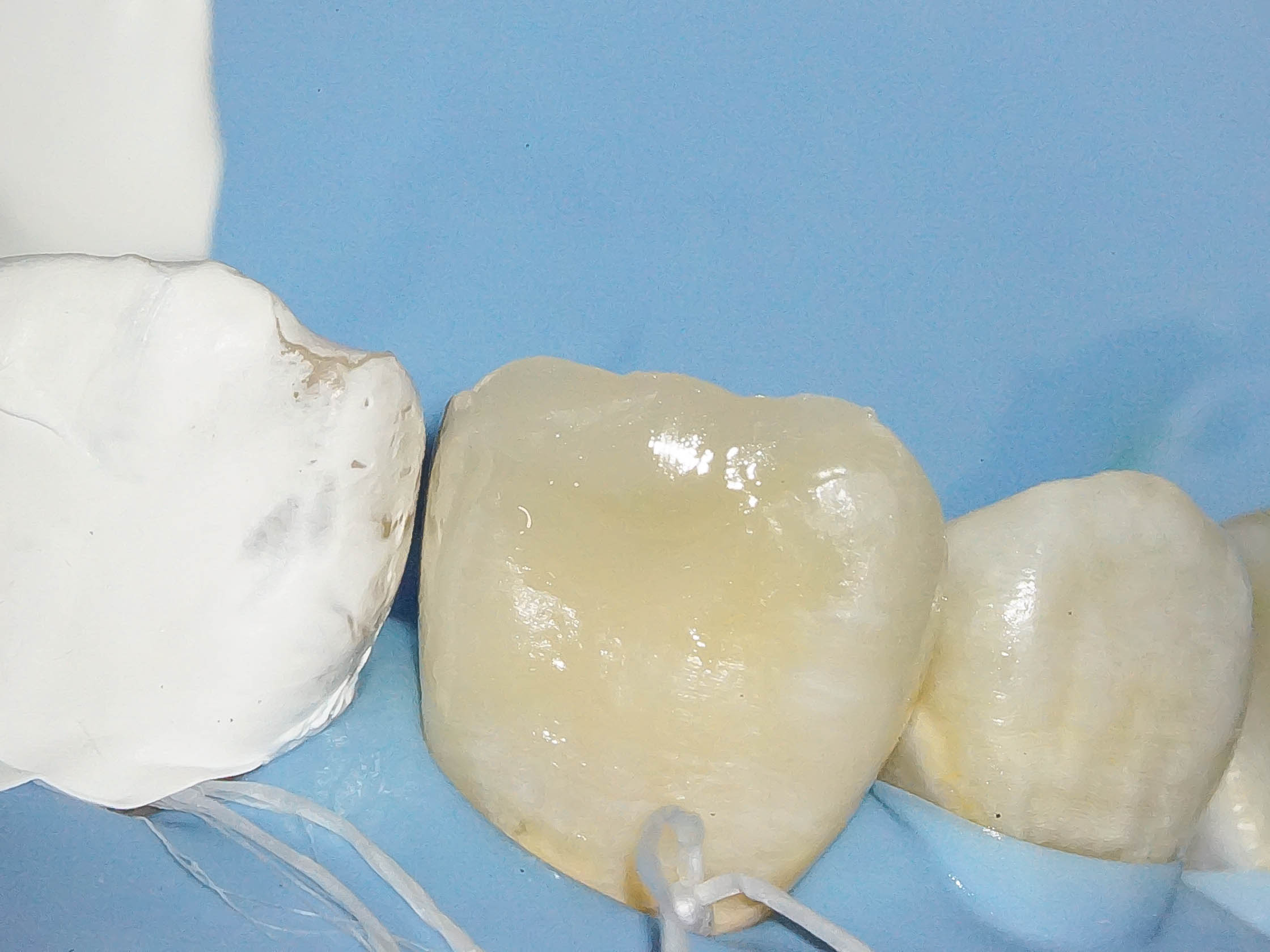 歯が折れた、歯が欠けたという外傷の状態をダイレクトボンディングにて修復2治療方法09