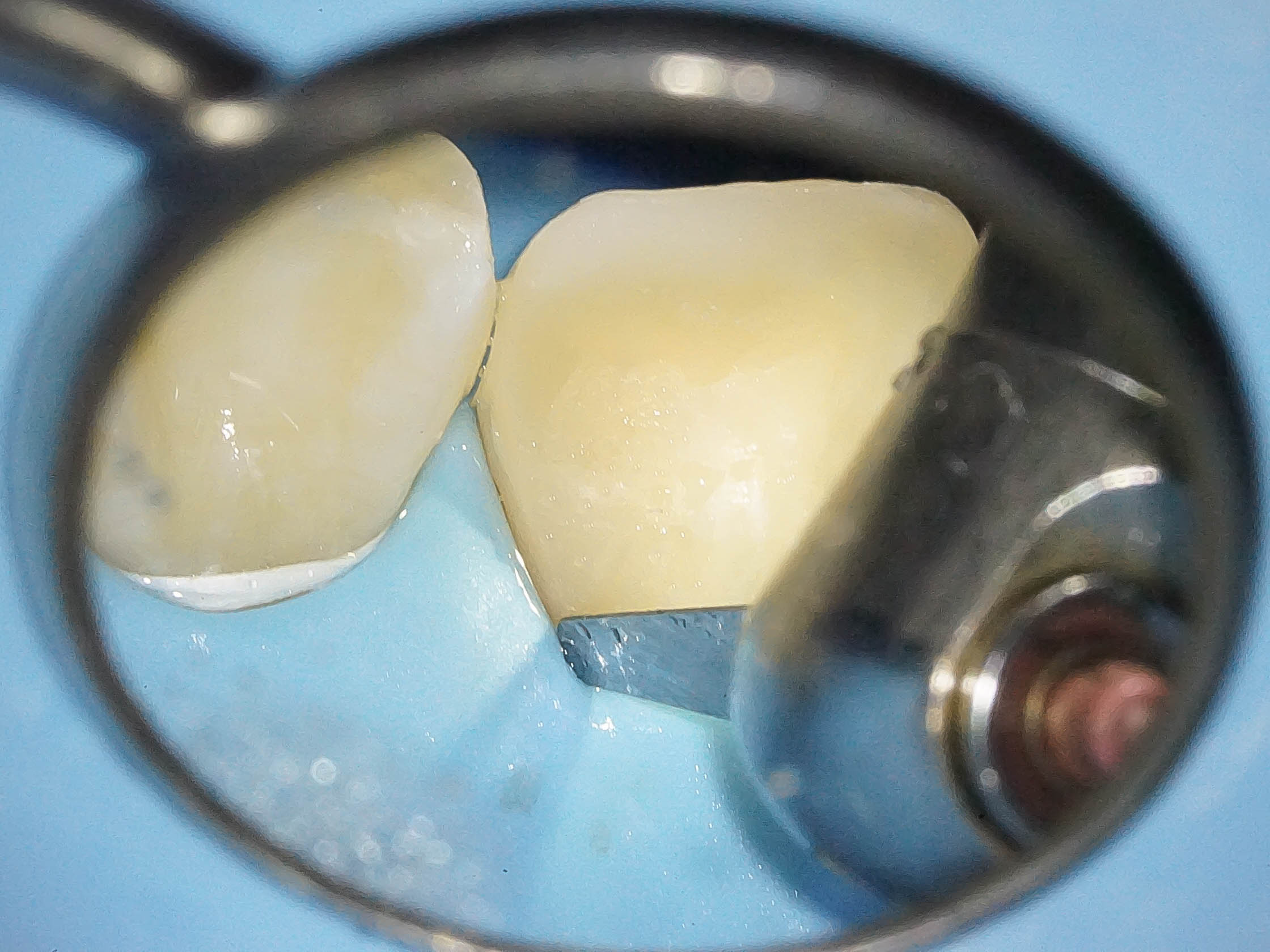 歯が折れた、歯が欠けたという外傷の状態をダイレクトボンディングにて修復2治療方法10