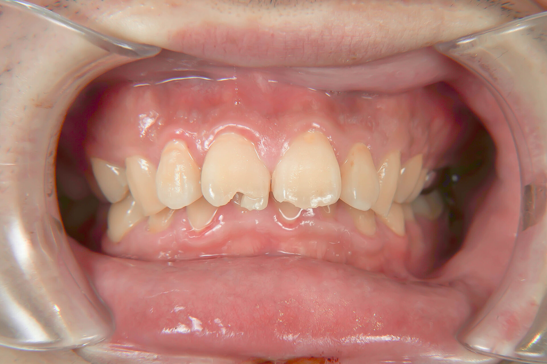 歯が折れた、歯が欠けたという外傷の状態をダイレクトボンディングにて修復2治療方法01