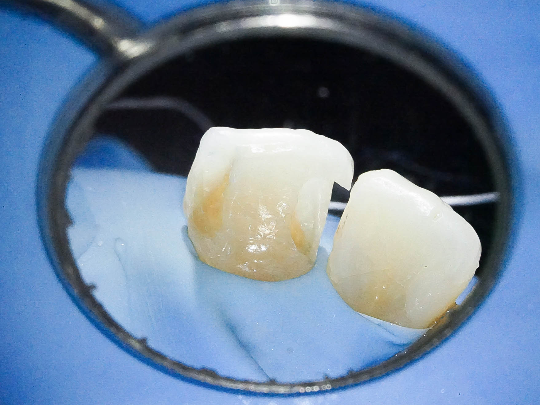 歯根破折により抜歯となった歯を機能的、審美的に回復させたケース治療方法05