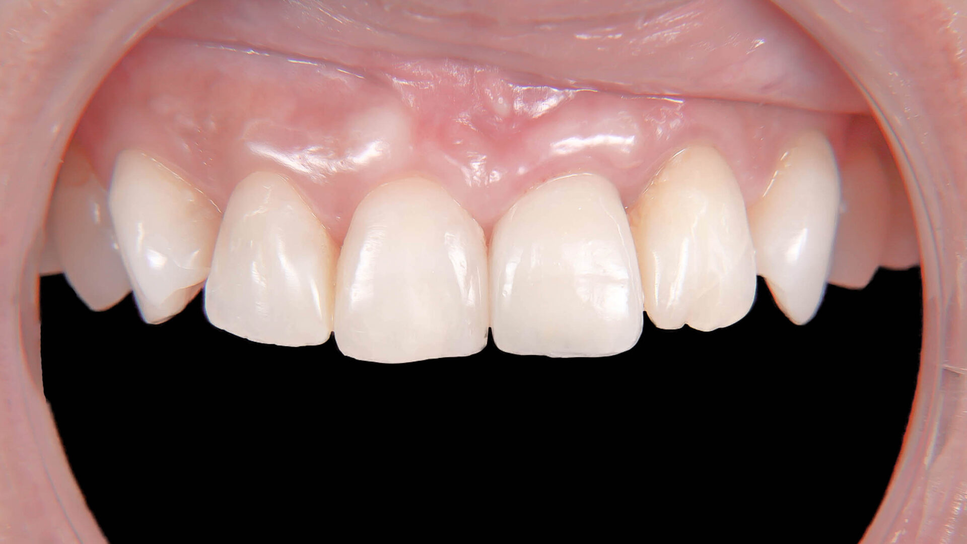 歯根破折により抜歯となった歯を機能的、審美的に回復させたケース