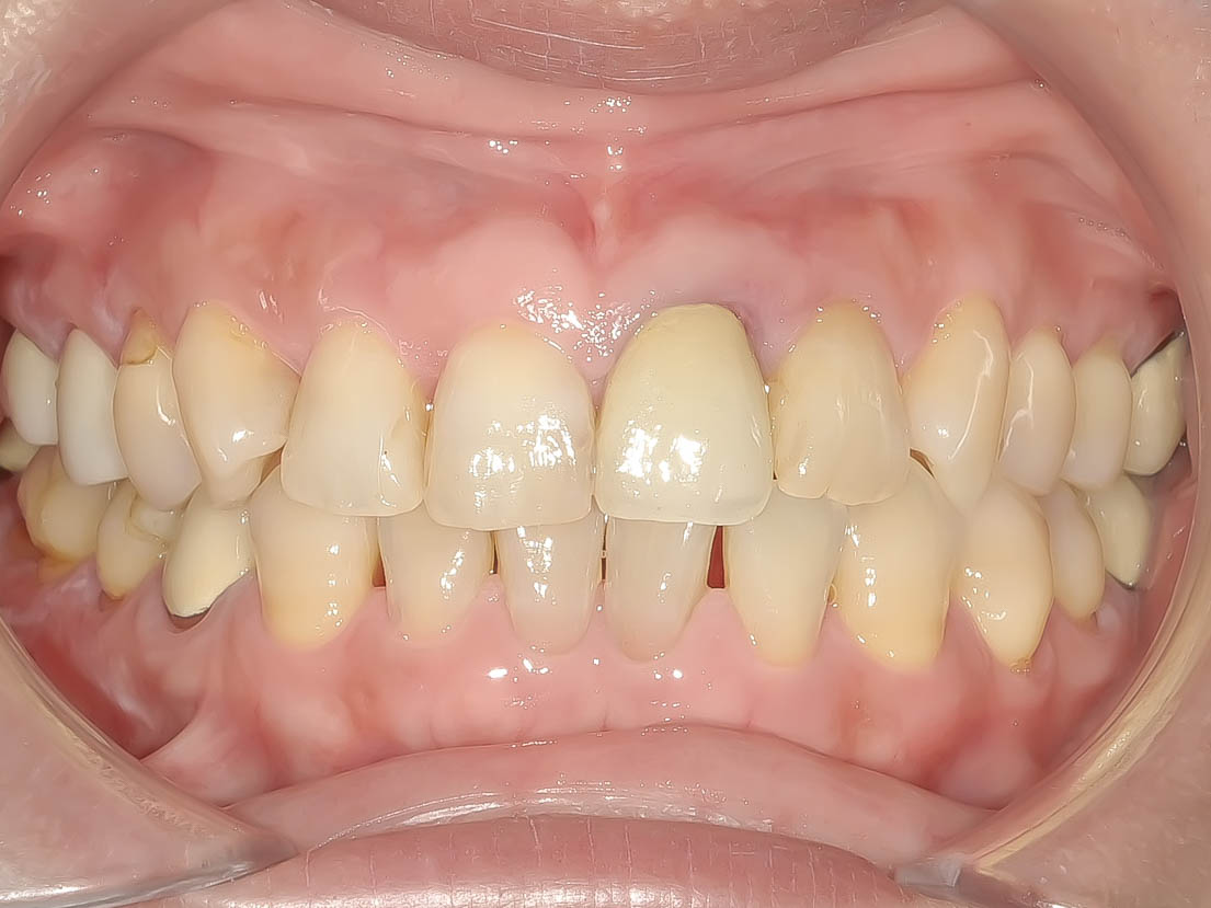 歯根破折により抜歯となった歯を機能的、審美的に回復させたケース治療方法01