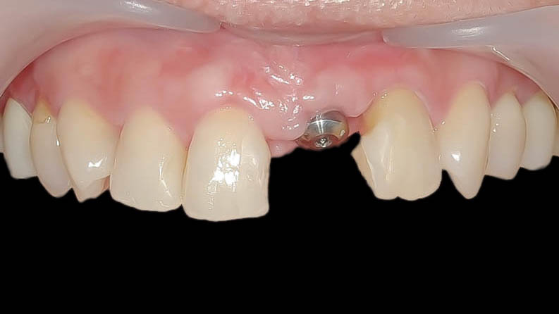 歯根破折により抜歯となった歯を機能的、審美的に回復させたケースBEFORE