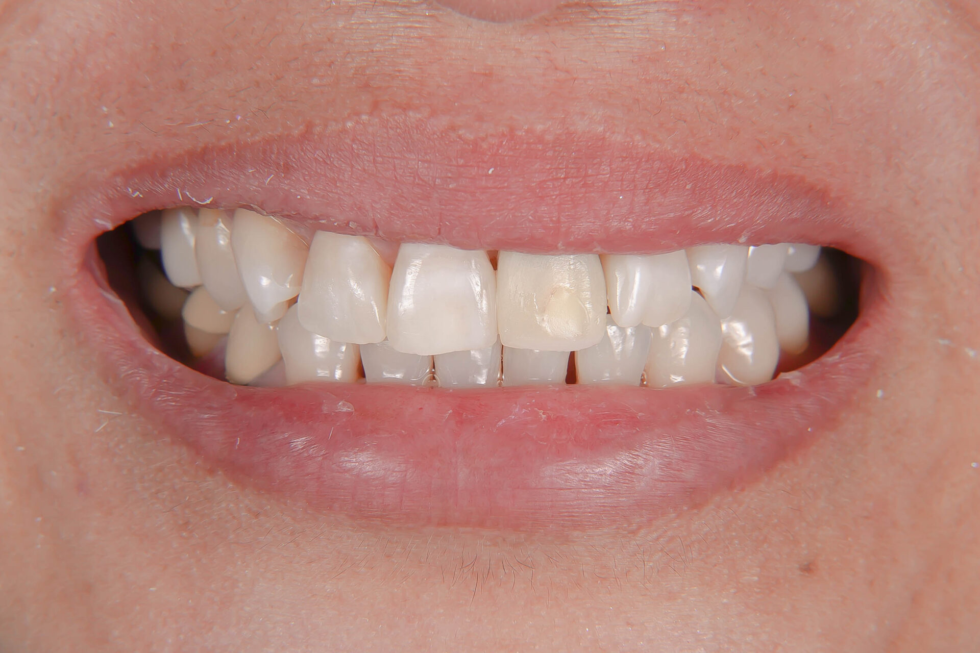 歯根破折により抜歯となった歯を機能的、審美的に回復させたケース治療方法06