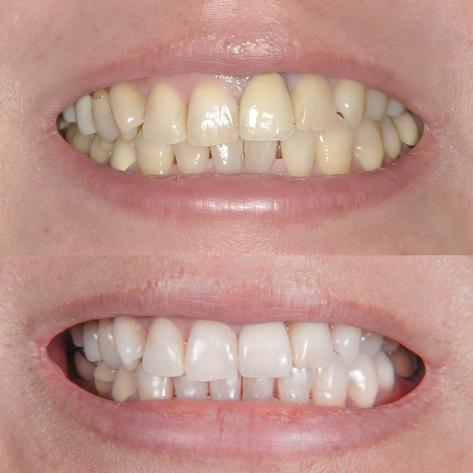 歯根破折により抜歯となった歯を機能的、審美的に回復させたケース治療方法08